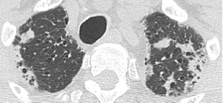 Radiologiset löydökset PPFE Ylälohkoihin ja keuhkojen kärkiin painottuvat