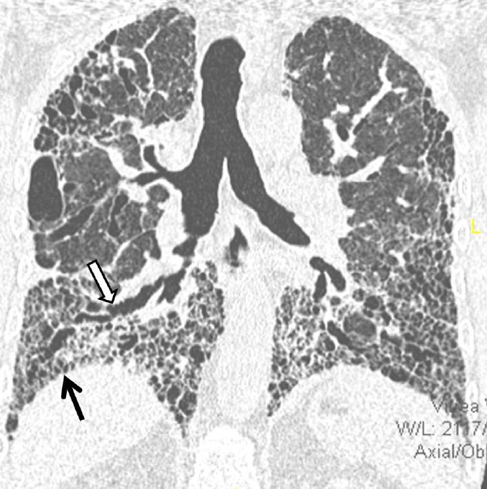 UIP:n aiheuttajat Idiopaattinen pulmonaalinen fibroosi= IPF yleisin Sidekudossairaudet Krooninen hypersensitiviteetti pneumoniitti Asbestoosi Familiaalinen Lääkeainereaktio (harvinainen) Epäile muuta