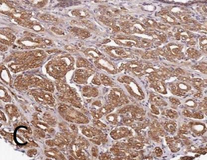 Moderate staining (score 2) D Strong staining (score 3).