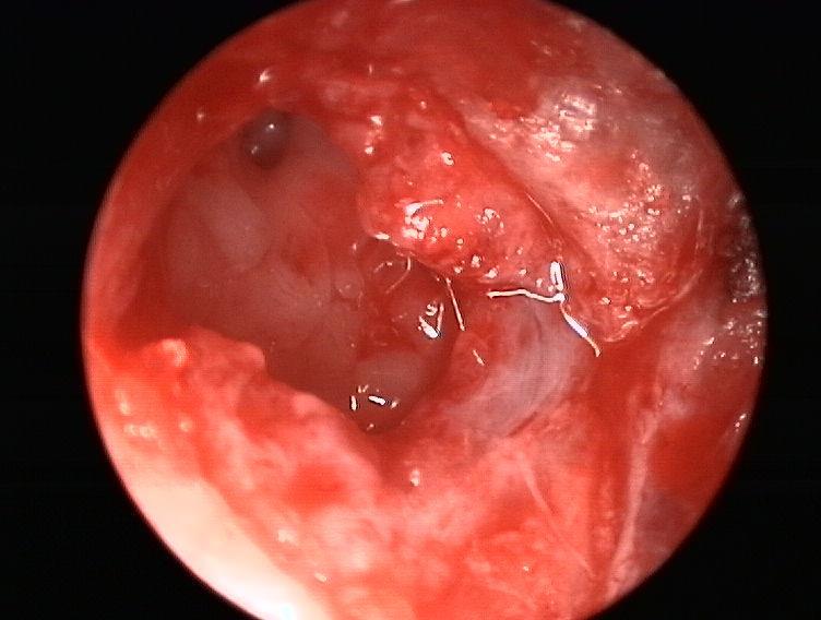 kyynelpussin luumen rhinostoma