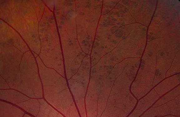 perifeerisen retinan degeneraatio