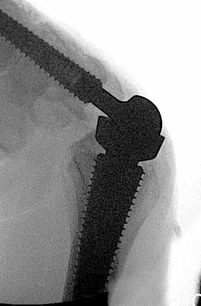 Jos implantoit Short-kaulaisen osan, voi ilmetä puristumia Radius Cup -osan (materiaalina PEEK tai CoCrMo) ja Metacarpal Threaded Implant -osan väliin.