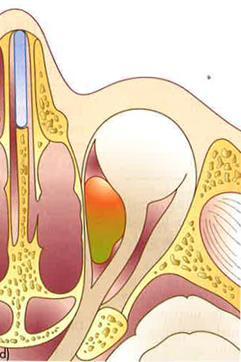 oftalmoplegia