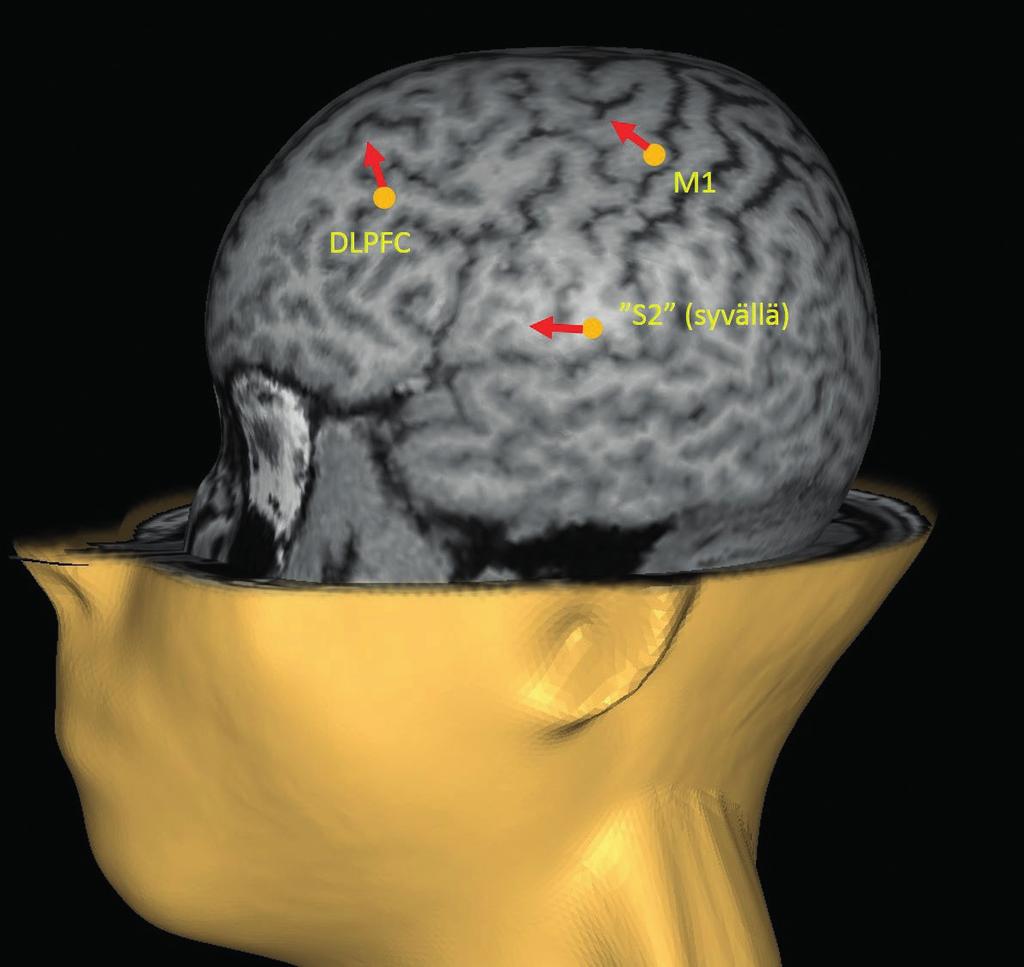 Neurostimulaatio Kuva 1. Tyypilliset TMS-hoidon kohdealueet. M1 tarkoittaa primaaria liikeaivokuorta, S2 sekundaarista tuntoaivokuorta ja DLPFC dorsolateraalista etuotsalohkon aluetta.