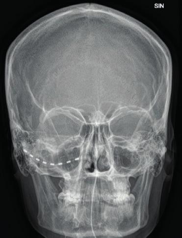 Neurostimulaatio 8-napainen elektrodijohto takaraivolla kallon röntgenkuvassa.