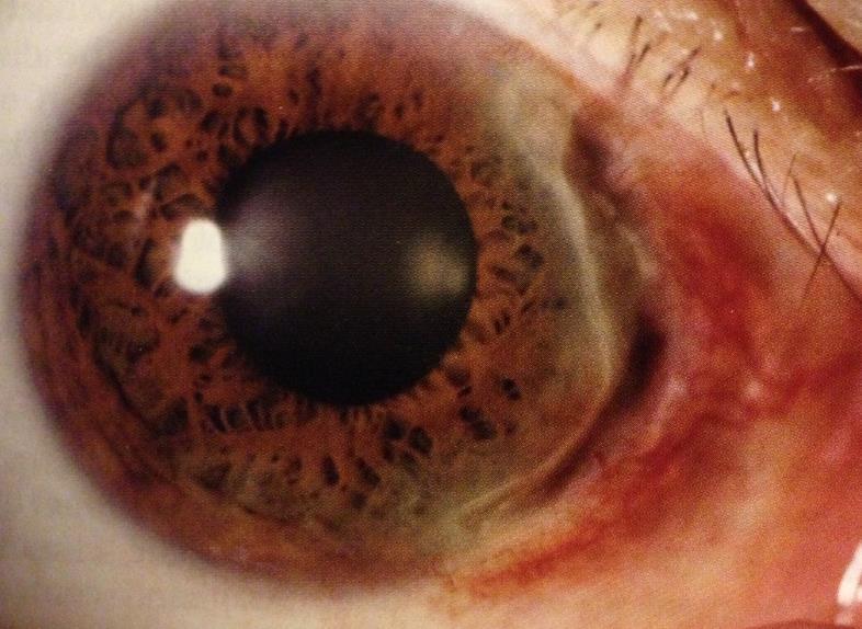 Mooren ulcus Punainen silmä Vetistys Valonarkuus Visus heikentynyt Sarveiskalvon perifeerinen progressiivinen oheneminen