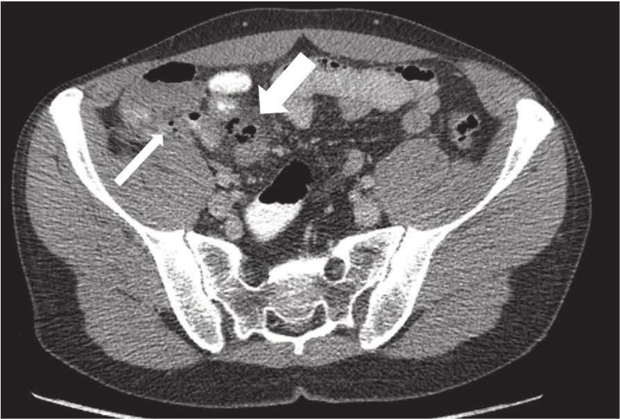 l fl ui d a cute a ppendi ci ti s wi th tumor Figure 1 On the left, CT image of normal appendix and on the right, an uncomplicated acute