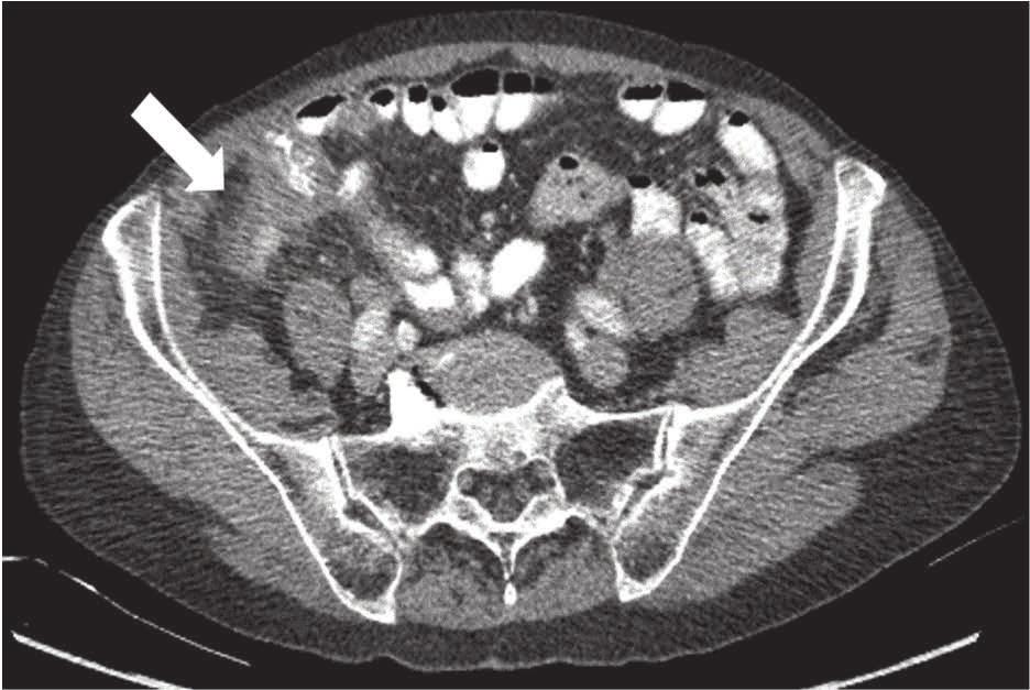4 Differential diagnosis of acute appendicitis The evaluation of patients with suspected acute appendicitis is driven by the goal of identifying all patients presenting with acute appendicitis as