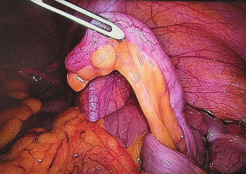 Review of literature 41 sults explain the prompt increase in the use of laparoscopic technique reported by Sahm et al (Sahm et al.