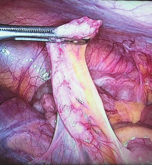 Both open and laparoscopic appendectomy techniques are still in clinical use round-the-clock.