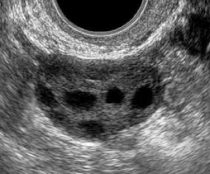 EROTUSDG: MULTIFOLLIKULAARINEN OVARIO (MFO) Nuoret naiset Hypotalaaminen amenorrea (urheilijat), hyperprolaktinemia