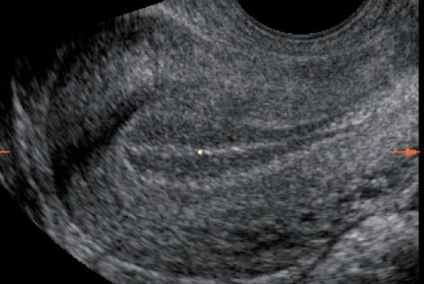 endometrium PCOS