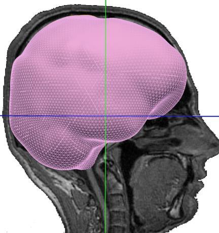 johtavuusmallin rakentaminen - TT ja MRI akuutti- ja seurantakuvaus (vuodon kasvu,