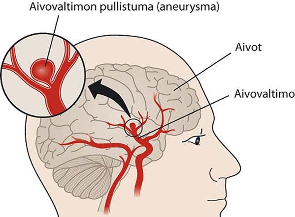 Pullistuma voi olla aivovaltimossa vuosia aiheuttamatta oireita, tai puhjeta aiheuttaen verenvuodon. Aneurysman syntyyn ei voida elintavoilla vaikuttaa.