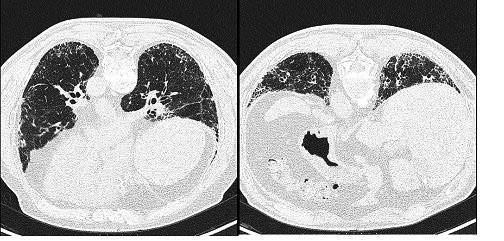 9 Figure 1. High-resolution computed tomography images of a patient with definite UIP pattern. Reticular pattern is basal and peripheral. Some bronchiectasis and honeycombing are evident.