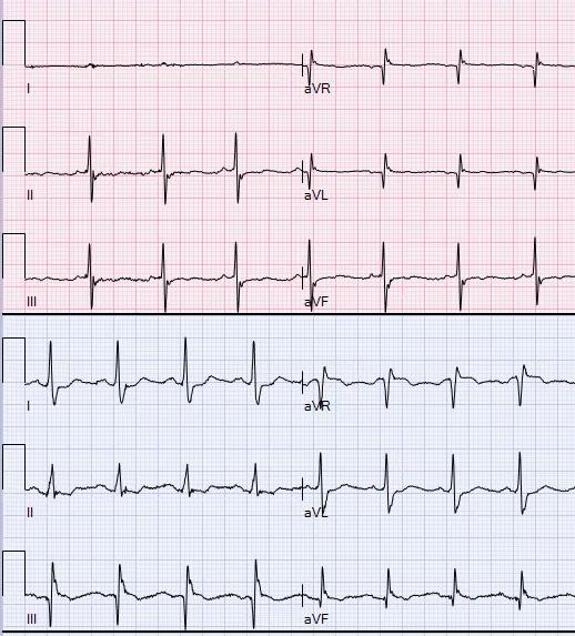 Johtimien virheellinen liitäminen (jatkoa ) LA-LL/ RA-RL reversal Lead I records a flat line