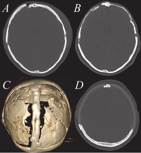Fig. 5. Bone flap resorption. A shows the intact bone flap one week after cranioplasty in a computed tomography scan. In B, the skull bone exactly one year after cranioplasty is shown.