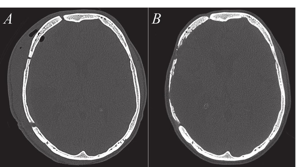Fig. 8. A patient with a right-sided autologous cranioplasty. The RBV and HU measurements on one axial level are shown.