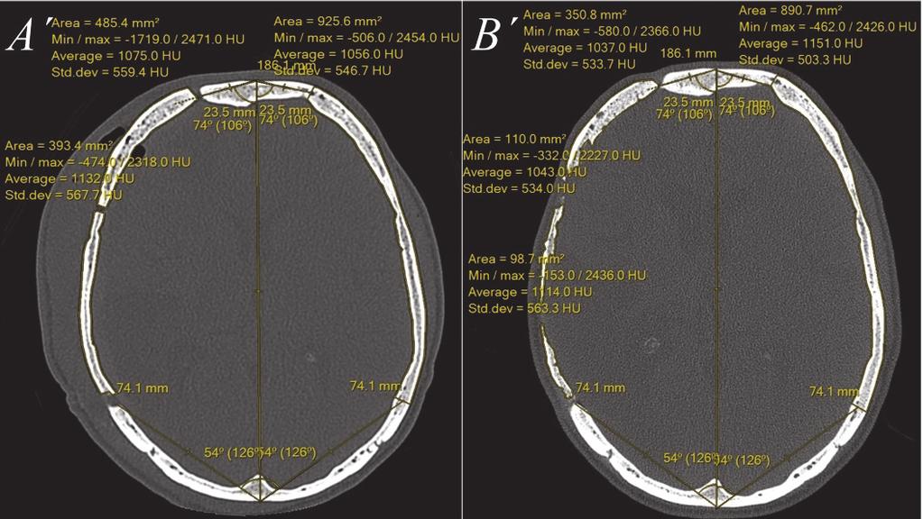Accordingly, B and B represent the follow-up CT scan with and without RBV and HU measurements taken 2 years 9 months after the IBF CT scan.