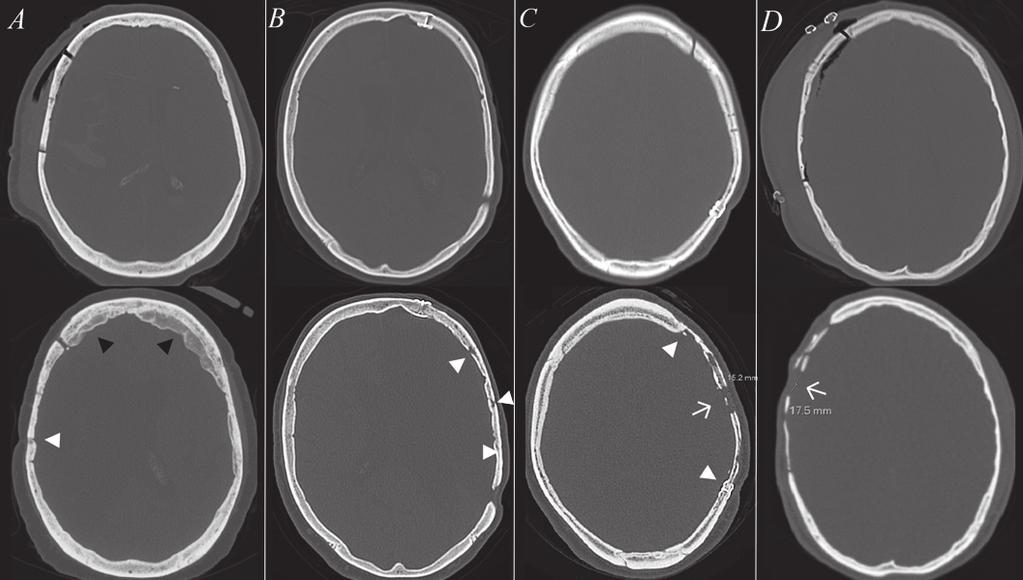 Fig. 11. Initial bone flap (IBF) (upper) and follow-up CT scans (lower) of four patients (A, B, C, D). Patient A was given a mean ORS of 0 (grade 0) as BFR changes were absent.