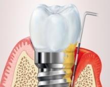 ympäröivän limakalvon tulehdus (periimplanttimukosiitti) - Muistuttaa gingiviittiä Kun