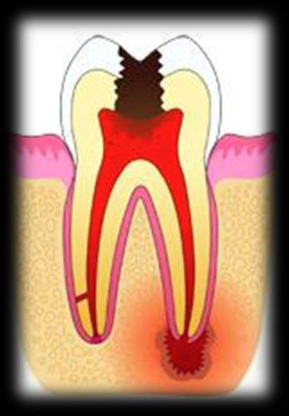 gingiviitti Hampaan kiinnityskudosten tulehdus eli