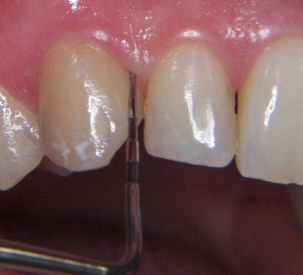 Hampaiden kiinnityskudosten tutkiminen Kuuluu suun terveydentilan tarkastukseen Tulehdustila todetaan mittaamalla Ientaskut Ienverenvuoto Useat