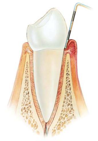 Ientulehdus (gingiviitti) Bakteeriplakin aiheuttama