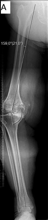 During the knee flexion, there is a complex pattern movement between the articular facets of the distal femur and proximal tibia.