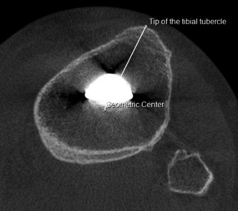 (B) Axial cone beam computed tomography (CBCT) image through the tip of the tibial tubercle. The geometric center was axially transposed at the level of the tibial tubercle.