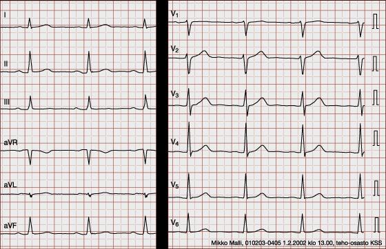 15 geenivika. Viimeisenä normaalissa EKG:ssä on havaittavissa T-aalto ja joillain henkilöillä myös U-aalto. (Jormakka & Kettunen 2018, 26-28, 36-38.