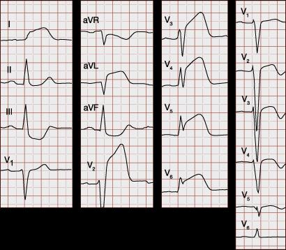 22 ST-tason nousu (kuva 9) kertoo yleensä infarktista, kokonaan tukkeutuneesta verisuonesta ja sydänlihassolujen kuolemisesta.