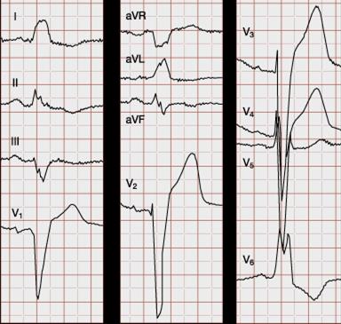 39 Vasen haarakatkos Tuore vasen haarakatkos akuutin sydäninfarktin yhteydessä lisää kuolleisuutta. Kytkennöissä V1 ja V2 näkyy syvä ja leveä heilahdus alaspäin, sekä ST-tason nousut.