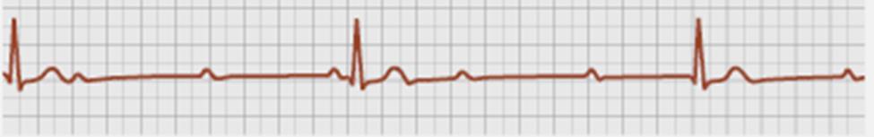 42 tule impulssia. Eli eteiset supistuvat säännöllisesti ja kammiot supistuvat säännöllisesti, mutta ne eivät ole kytköksissä toisiinsa (kuva 29). Kammiotaajuus on aina eteisten taajuutta hitaampi.
