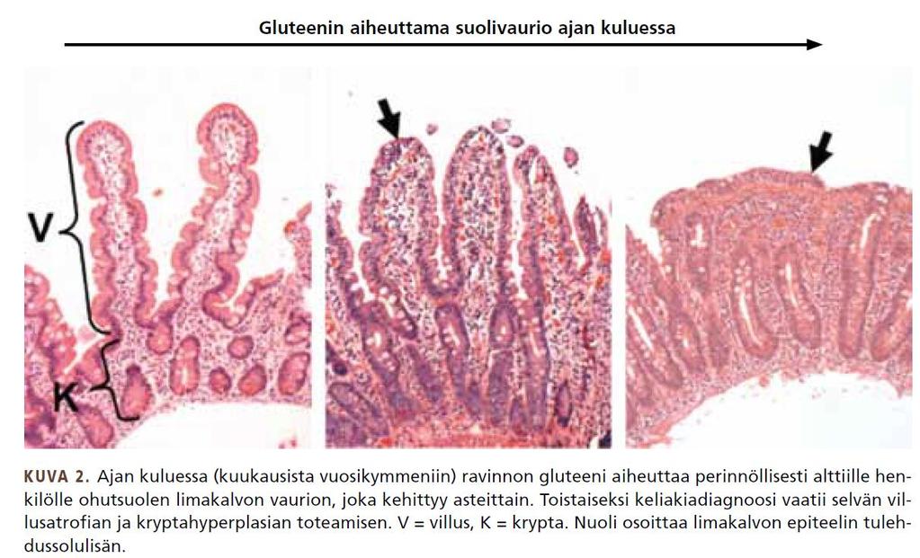 Allergia - Aiheuttaja: pääasiassa eläin- tai kasviperäiset proteiinit -