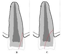 Kliinisesti traumahampaan koronaalisessa osassa on lisääntynyttä liikkuvuutta ja hammas on koputusarka. Radiologisesti hampaan juurimurtuma sijaitsee usein juuren apikaali- tai keskiosassa.