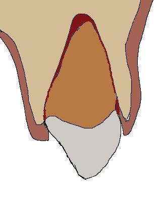 2.3.3. Avulsio Hampaan avulsiolla tarkoitetaan hampaan täydellistä irtoamista alveolikuopasta. Tyypillisesti pysyvän hampaan avulsio tapahtuu 7-9 vuoden iässä, kun inkisiivit ovat puhkeamassa.