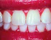 Hammaslääkäri käyttää sitä yhden tai useamman hampaan tai hampaan osan valkaisuun sekä nopeaan valkaisuun hammaslääkärin tuolissa.