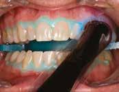 Varoitus: Hammaslääkärin, hammashoitajan ja potilaan on käytettävä suojalaseja vastaanottokäyttöön tarkoitetun Opalescence Boost -valkaisuaineen sekoituksen ja applikoinnin aikana.