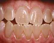 Hampaiden valkaisuun tarkoitettuja lääkinnällisiä laitteita ei ole saatavilla joissakin Euroopan yhteisön maissa.