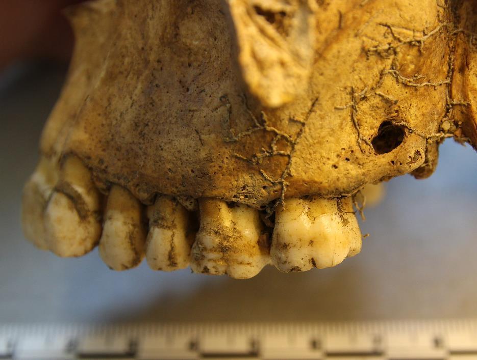 Yläleuassa vasemmalla puolella kolmannessa poskihampaassa on vain juuri jäljellä ja lisäksi hampaan yläpuolella on reikä leukaluun läpi.
