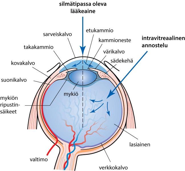5 LÄÄKEMUODOT JA ANNOSTELUTIET Useimmiten silmälääkehoito koostuu silmätipoista ja -voiteista, joita annostellaan paikallisesti. Pääosin nämä lääkkeet kulkeutuvat silmään sarveiskalvon kautta.
