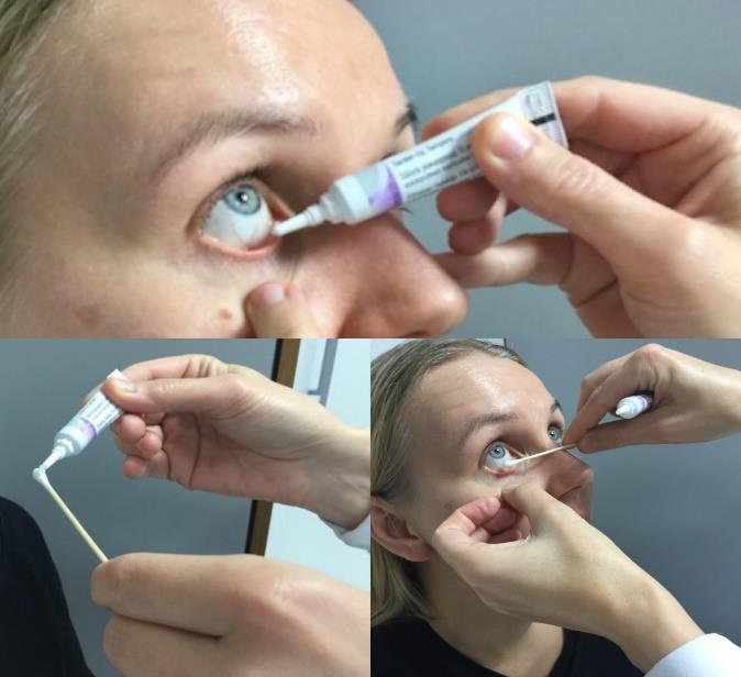 9 3.3 Silmävoiteen annostelu -Puhdista silmäluomet ja ripsiraja tarvittaessa puhtaaseen veteen kostutetulla vanulapulla tai taitoksella ennen lääkkeen antoa.