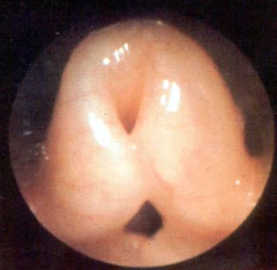 POISEUILLE-HAGENIN LAKI R = 8 L/ r 4