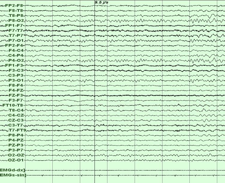 Normaali EEG