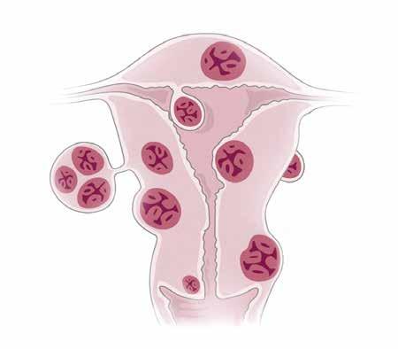 Intramuraalisia myoomia Kohdun seinämä Limakalvonalainen varrellinen myooma Munanjohdin Kohdun limakalvo Intraligamentaarinen myooma