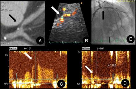 Esa Joutsiniemi was kept as small as possible and used angle correction. In some coronary segments, because of the artery s horizontal course, the angle between ultrasound beam and flow remained >60.