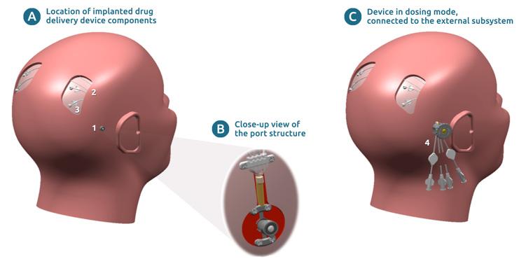 CDNF-yhteistyön tavoite: läpimurto Parkinsonin taudin hoidossa CDNF suojaa tehokkaasti dopamiinihermosoluja useissa Parkinsonin tautimalleissa Prekliinisen datan perusteella CDNF voi