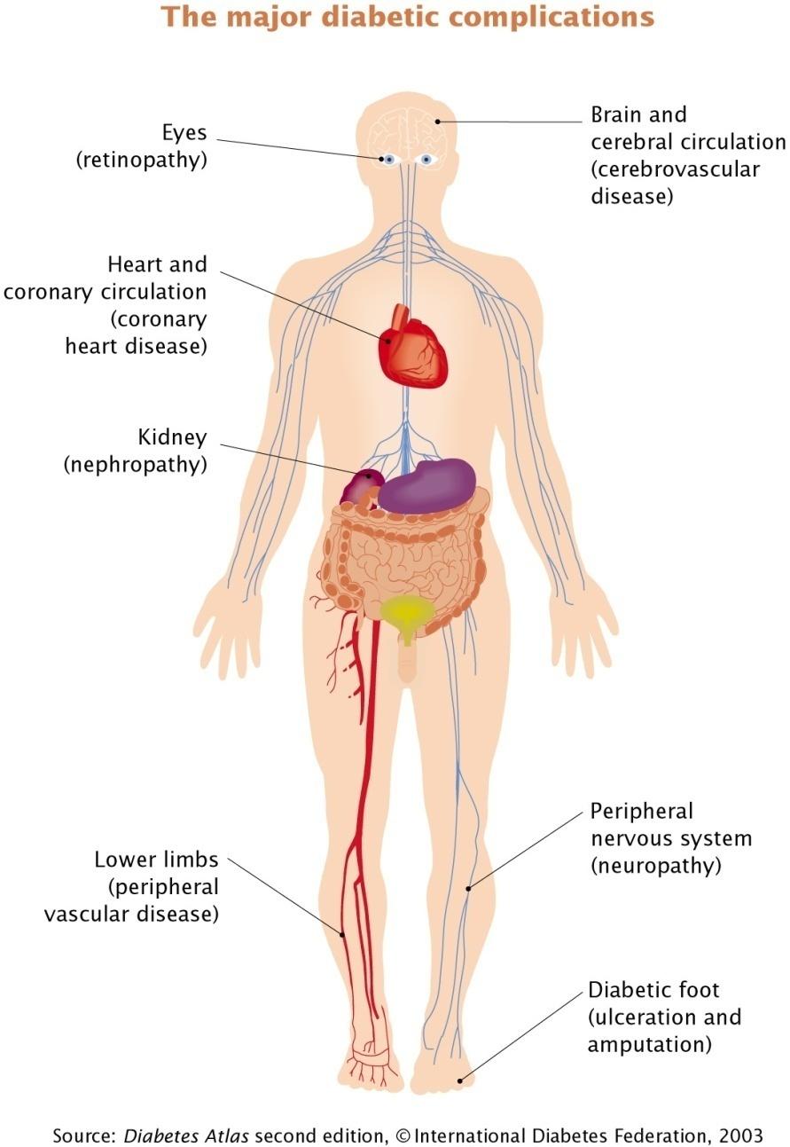 Diabeteksen komplikaanot 70-80%