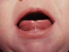 and the floor of the mouth that restricts normal tongue movement IATP International